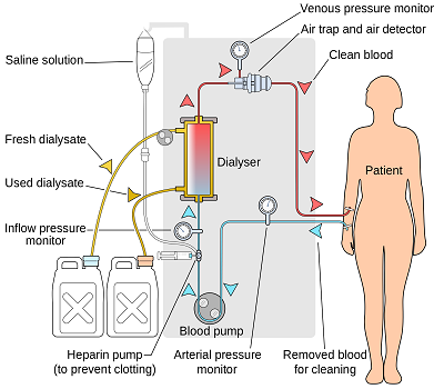 Dialysis Treatment in Pimpri Chinchwad