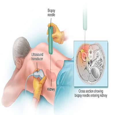 Kidney Biopsy